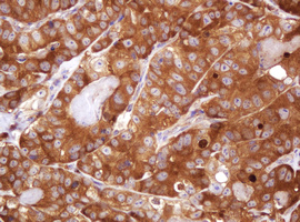 VBP1 Antibody - IHC of paraffin-embedded Adenocarcinoma of Human colon tissue using anti-VBP1 mouse monoclonal antibody. (Heat-induced epitope retrieval by 10mM citric buffer, pH6.0, 120°C for 3min).