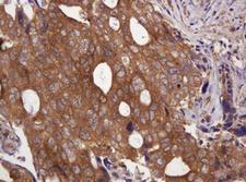 VBP1 Antibody - IHC of paraffin-embedded Adenocarcinoma of Human breast tissue using anti-VBP1 mouse monoclonal antibody. (Heat-induced epitope retrieval by 10mM citric buffer, pH6.0, 120°C for 3min).