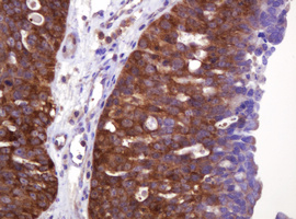VBP1 Antibody - IHC of paraffin-embedded Adenocarcinoma of Human ovary tissue using anti-VBP1 mouse monoclonal antibody. (Heat-induced epitope retrieval by 10mM citric buffer, pH6.0, 120°C for 3min).