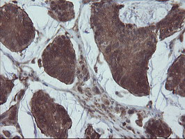 VBP1 Antibody - IHC of paraffin-embedded Carcinoma of Human pancreas tissue using anti-VBP1 mouse monoclonal antibody.