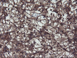 VBP1 Antibody - IHC of paraffin-embedded Carcinoma of Human kidney tissue using anti-VBP1 mouse monoclonal antibody.