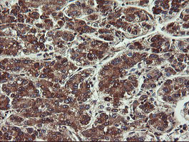 VBP1 Antibody - IHC of paraffin-embedded Carcinoma of Human liver tissue using anti-VBP1 mouse monoclonal antibody.