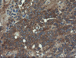 VBP1 Antibody - IHC of paraffin-embedded Carcinoma of Human pancreas tissue using anti-VBP1 mouse monoclonal antibody.