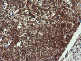 VBP1 Antibody - IHC of paraffin-embedded Carcinoma of Human bladder tissue using anti-VBP1 mouse monoclonal antibody.