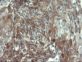 VBP1 Antibody - IHC of paraffin-embedded Carcinoma of Human lung tissue using anti-VBP1 mouse monoclonal antibody.