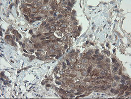 VBP1 Antibody - IHC of paraffin-embedded Adenocarcinoma of Human breast tissue using anti-VBP1 mouse monoclonal antibody.
