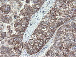 VBP1 Antibody - IHC of paraffin-embedded Adenocarcinoma of Human ovary tissue using anti-VBP1 mouse monoclonal antibody.