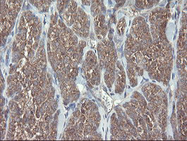 VBP1 Antibody - IHC of paraffin-embedded Carcinoma of Human thyroid tissue using anti-VBP1 mouse monoclonal antibody.