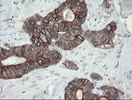 VBP1 Antibody - IHC of paraffin-embedded Adenocarcinoma of Human colon tissue using anti-VBP1 mouse monoclonal antibody.