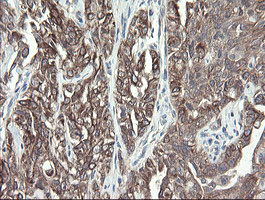 VBP1 Antibody - IHC of paraffin-embedded Carcinoma of Human kidney tissue using anti-VBP1 mouse monoclonal antibody.