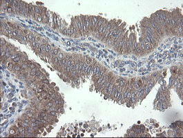 VBP1 Antibody - IHC of paraffin-embedded Adenocarcinoma of Human endometrium tissue using anti-VBP1 mouse monoclonal antibody.