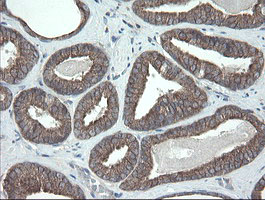 VBP1 Antibody - IHC of paraffin-embedded Carcinoma of Human prostate tissue using anti-VBP1 mouse monoclonal antibody.