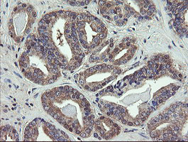 VBP1 Antibody - IHC of paraffin-embedded Carcinoma of Human prostate tissue using anti-VBP1 mouse monoclonal antibody.