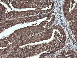 VBP1 Antibody - IHC of paraffin-embedded Adenocarcinoma of Human endometrium tissue using anti-VBP1 mouse monoclonal antibody.