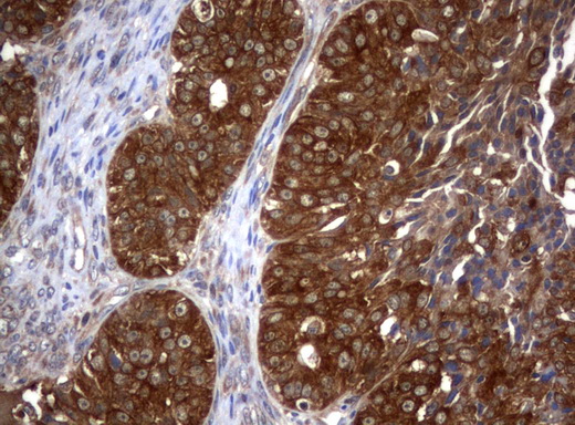 VBP1 Antibody - Immunohistochemical staining of paraffin-embedded Adenocarcinoma of Human ovary tissue using anti-VBP1 mouse monoclonal antibody.  heat-induced epitope retrieval by 10mM citric buffer, pH6.0, 120C for 3min)