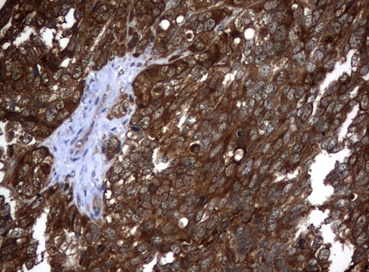 VBP1 Antibody - Immunohistochemical staining of paraffin-embedded Adenocarcinoma of Human endometrium tissue using anti-VBP1 mouse monoclonal antibody.  heat-induced epitope retrieval by 10mM citric buffer, pH6.0, 120C for 3min)