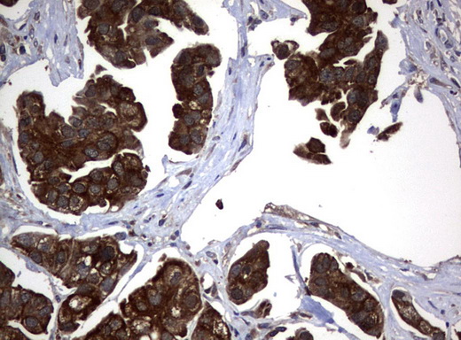 VBP1 Antibody - Immunohistochemical staining of paraffin-embedded Carcinoma of Human bladder tissue using anti-VBP1 mouse monoclonal antibody.  heat-induced epitope retrieval by 10mM citric buffer, pH6.0, 120C for 3min)