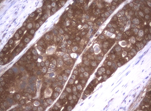 VBP1 Antibody - Immunohistochemical staining of paraffin-embedded Adenocarcinoma of Human colon tissue using anti-VBP1 mouse monoclonal antibody.  heat-induced epitope retrieval by 10mM citric buffer, pH6.0, 120C for 3min)