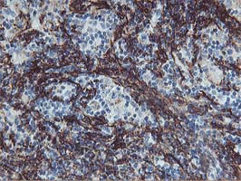 VCAM1 / CD106 Antibody - IHC of paraffin-embedded Human lymphoma tissue using anti-VCAM1 mouse monoclonal antibody. (Heat-induced epitope retrieval by 10mM citric buffer, pH6.0, 100C for 10min).