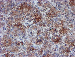 VCAM1 / CD106 Antibody - IHC of paraffin-embedded Carcinoma of Human liver tissue using anti-VCAM1 mouse monoclonal antibody.