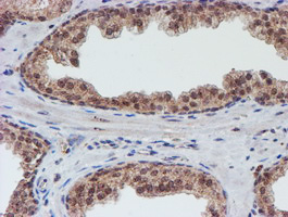 VCAM1 / CD106 Antibody - IHC of paraffin-embedded Carcinoma of Human prostate tissue using anti-VCAM1 mouse monoclonal antibody.