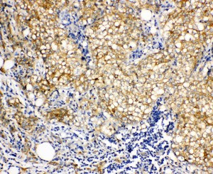 VCL / Vinculin Antibody - VCL / Vinculin antibody. IHC(P): Human Breast Cancer Tissue.