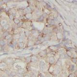 VCL / Vinculin Antibody - Immunohistochemistry of paraffin-embedded human breast cancer tissue slide using Vinculin antibody at dilution of 1:200