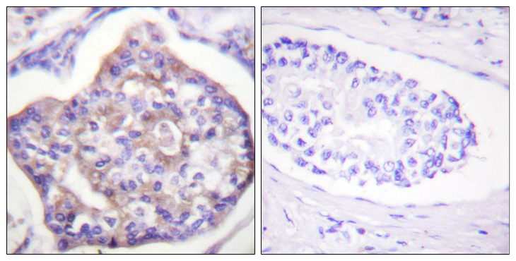 VCL / Vinculin Antibody - Immunohistochemistry analysis of paraffin-embedded human breast carcinoma, using Vinculin (Phospho-Tyr821) Antibody. The picture on the right is blocked with the phospho peptide.