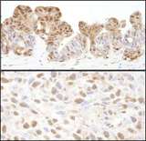 VCP Antibody - Detection of Human and Mouse VCP by Immunohistochemistry. Sample: FFPE sections of human ovarian carcinoma (upper) and mouse squamous cell carcinoma (lower). Antibody: Affinity purified rabbit anti-VCP used at a dilution of 1:200 (1 Detection: DAB.