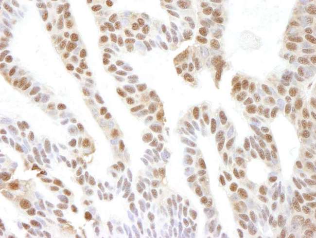 VCP Antibody - Detection of Human VCP by Immunohistochemistry. Sample: FFPE section of human skin basal cell carcinoma. Antibody: Affinity purified rabbit anti-VCP used at a dilution of 1:250. Detection: DAB staining using anti-Rabbit IHC antibody at a dilution of 1:100.