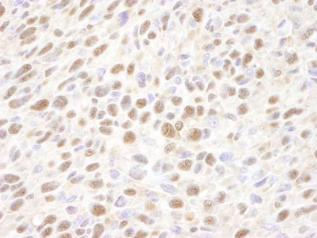 VCP Antibody - Detection of Mouse VCP by Immunohistochemistry. Sample: FFPE section of mouse squamous cell carcinoma. Antibody: Affinity purified rabbit anti-VCP used at a dilution of 1:250. Detection: DAB staining using anti-Rabbit IHC antibody at a dilution of 1:100.