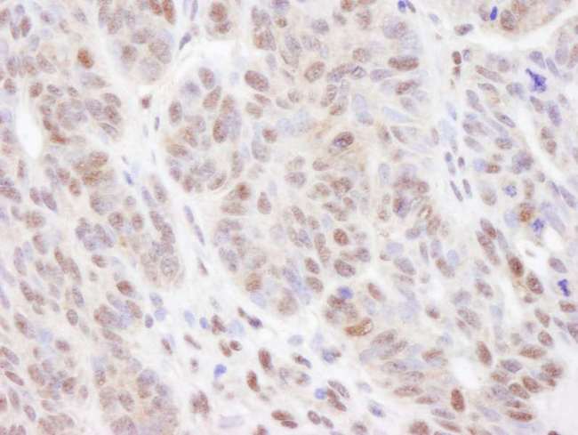 VCP Antibody - Detection of Human VCP by Immunohistochemistry. Sample: FFPE section of human skin basal cell carcinoma. Antibody: Affinity purified rabbit anti- VCP used at a dilution of 1:200 (1 Detection: DAB.