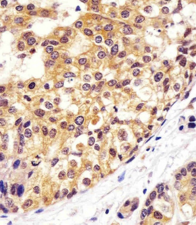 VCP Antibody - Antibody staining VCP in human breast carcinoma sections by Immunohistochemistry (IHC-P - paraformaldehyde-fixed, paraffin-embedded sections). Tissue was fixed with formaldehyde and blocked with 3% BSA for 0. 5 hour at room temperature; antigen retrieval was by heat mediation with a citrate buffer (pH 6). Samples were incubated with primary antibody (1:25) for 1 hours at 37°C. A undiluted biotinylated goat polyvalent antibody was used as the secondary antibody.