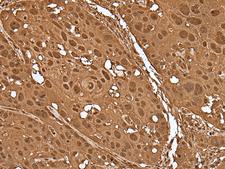 VCP Antibody - Immunohistochemistry of paraffin-embedded Human esophagus cancer tissue  using VCP Polyclonal Antibody at dilution of 1:30(×200)