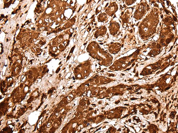 VCP Antibody - Immunohistochemistry of paraffin-embedded Human breast cancer tissue  using VCP Polyclonal Antibody at dilution of 1:30(×200)