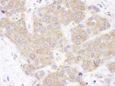VCPIP1 Antibody - Detection of Human VCIP135 by Immunohistochemistry. Sample: FFPE section of human breast carcinoma. Antibody: Affinity purified rabbit anti-VCIP135 used at a dilution of 1:200 (1 ug/ml). Detection: DAB.