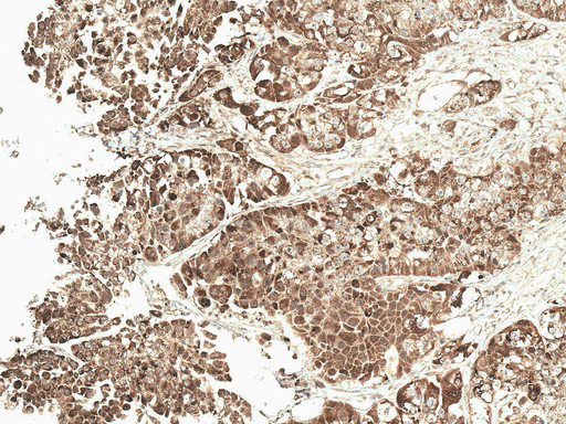 VDAC1 / PORIN Antibody - Immunohistochemistry analysis using Rabbit Anti-VDCA-1 Polyclonal Antibody. Tissue: Ovarian Cancer. Species: Human. Fixation: Formalin Fixed Paraffin-Embedded. Primary Antibody: Rabbit Anti-VDCA-1 Polyclonal Antibody  at 1:50 for 30 min at RT. Counterstain: Hematoxylin. Magnification: 20X.