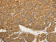VDAC2 Antibody - Immunohistochemistry of paraffin-embedded Human liver cancer tissue  using VDAC2 Polyclonal Antibody at dilution of 1:25(×200)