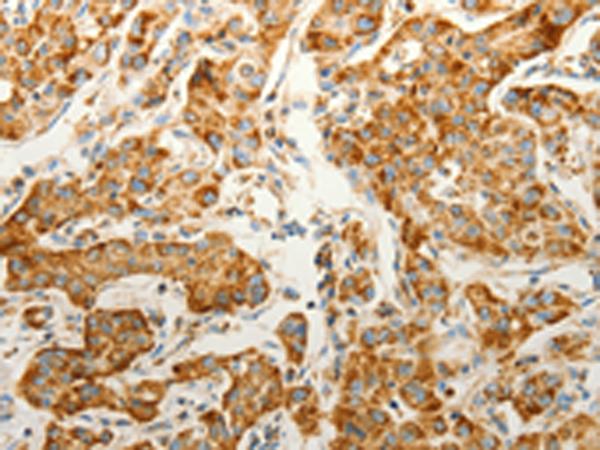 VDAC2 Antibody - Immunohistochemistry of paraffin-embedded Human lung cancer tissue  using VDAC2 Polyclonal Antibody at dilution of 1:25(×200)