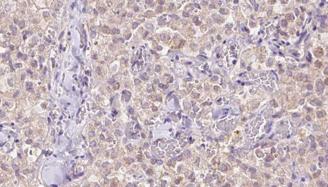 VDAC3 Antibody - 1:100 staining human thyroid carcinoma tissue by IHC-P. The sample was formaldehyde fixed and a heat mediated antigen retrieval step in citrate buffer was performed. The sample was then blocked and incubated with the antibody for 1.5 hours at 22°C. An HRP conjugated goat anti-rabbit antibody was used as the secondary.