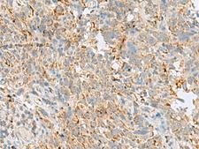 VDAC3 Antibody - Immunohistochemistry of paraffin-embedded Human cervical cancer tissue  using VDAC3 Polyclonal Antibody at dilution of 1:30(×200)