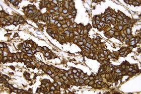 Product - Breast Cancer: c-erbB2 oncoprotein stained using VECTASTAIN® Elite® ABC Kit and Vector® DAB (brown) substrate. Hematoxylin QS (blue) counterstain.