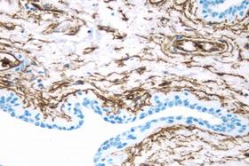 Product - Breast Cancer: CD34 antigen stained using VECTASTAIN® Elite® ABC Kit and Vector® DAB (brown) substrate. Hematoxylin QS (blue) counterstain.