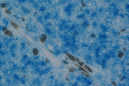 Product - Melanoma: Anti-Vimentin (rabbit mab), ImmPRESS-AP Anti-Rabbit IgG, Vector Blue™ Substrate (blue).