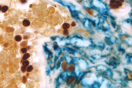 Product - Breast Carcinoma (triple label): Estrogen Receptor (m), VECTASTAIN® Elite® ABC Kit, Vector® NovaRED® substrate (red); CD34 (m), VECTASTAIN® ABC-AP Kit, Vector Blue™ substrate (blue); Cytokeratin 8/18 (m), VECTASTAIN® Elite® ABC Kit, DAB substrate (brown).