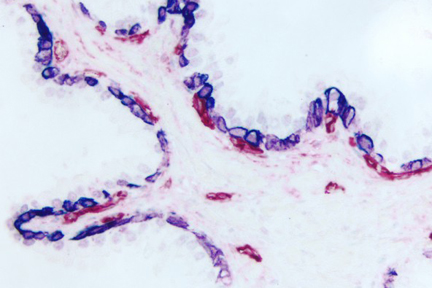 Product - Prostate (double label): Cytokeratin (m), VECTASTAIN® ABC-AP Kit, Vector Blue™ (blue) substrate. CD34, VECTASTAIN® ABC-AP Kit, Vector Red™ (red) substrate.
