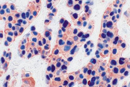 Product - Tumor (double label): p53 (m), VECTASTAIN® ABC-AP Kit, Vector Blue™ substrate (blue); Multi-Cytokeratin (m), VECTASTAIN® Elite® ABC Kit, AEC substrate (red).