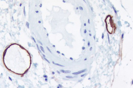 Product - Colon submucosa: Lymphatic endothelium stained using mouse monoclonal antibody against M2A antigen (clone D2-40), ImmPRESS™ anti-mouse Ig reagent (LS-J1061), and Vector® NovaRED® peroxidase substrate (LS-J1084; red). Hematoxylin QS counterstain.