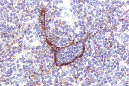 Product - Lymphoma: Lymphatic endothelium stained using mouse monoclonal antibody against M2A antigen (clone D2-40), ImmPRESS™ anti-mouse Ig reagent (LS-J1061), and Vector® NovaRED® peroxidase substrate (LS-J1084; red). Hematoxylin QS counterstain (blue).