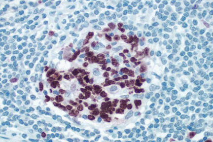 Product - Peyers Patch: ImmPRESS™ anti-rabbit Ig using Ki67 rabbit primary antibody with Vector® NovaRED® (red) substrate. Hematoxylin QS counterstain (blue).